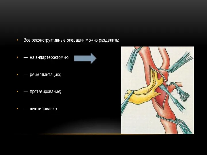 Все реконструктивные операции можно разделить: — на эндартерэктомию — реимплантацию; — протезирование; — шунтирование.