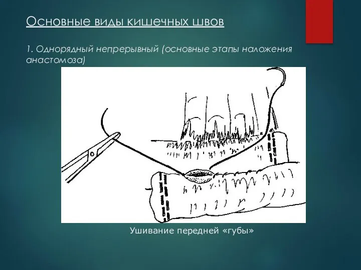 Основные виды кишечных швов 1. Однорядный непрерывный (основные этапы наложения анастомоза) Ушивание передней «губы»