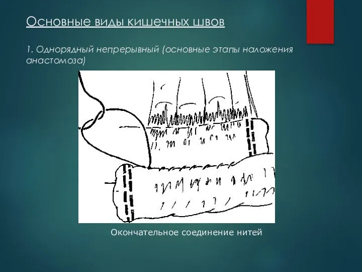 Основные виды кишечных швов 1. Однорядный непрерывный (основные этапы наложения анастомоза) Окончательное соединение нитей