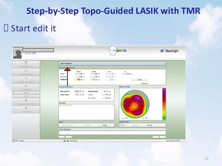 Step-by-Step Topo-Guided LASIK with TMR Start edit it