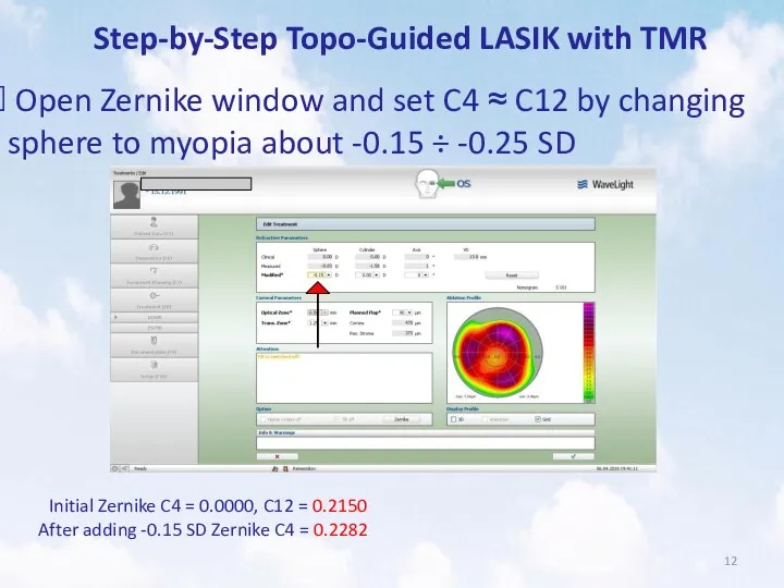 Step-by-Step Topo-Guided LASIK with TMR Open Zernike window and set
