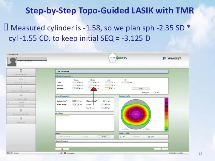 Step-by-Step Topo-Guided LASIK with TMR Measured cylinder is -1.58, so