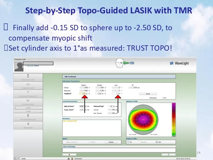 Step-by-Step Topo-Guided LASIK with TMR Finally add -0.15 SD to