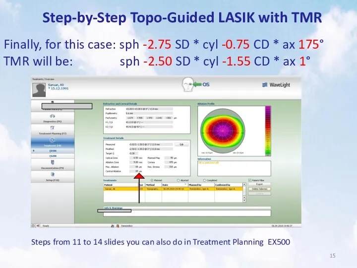 Step-by-Step Topo-Guided LASIK with TMR Finally, for this case: sph