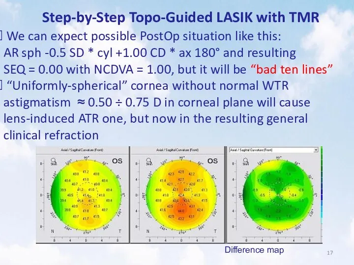 Step-by-Step Topo-Guided LASIK with TMR We can expect possible PostOp