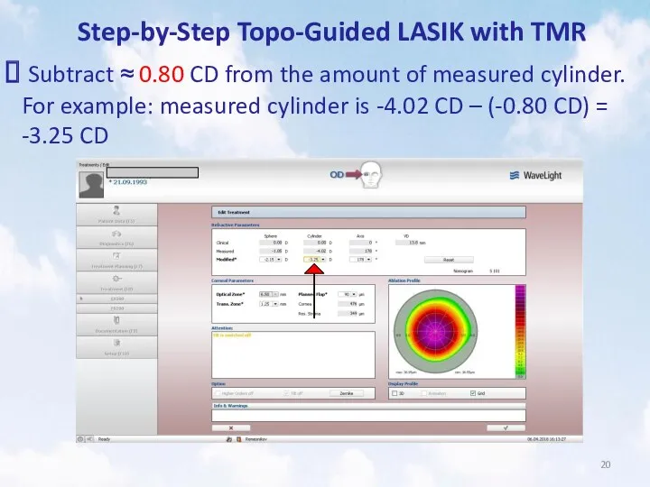 Step-by-Step Topo-Guided LASIK with TMR Subtract ≈ 0.80 CD from