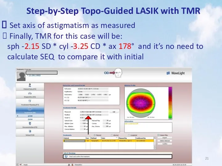 Step-by-Step Topo-Guided LASIK with TMR Set axis of astigmatism as