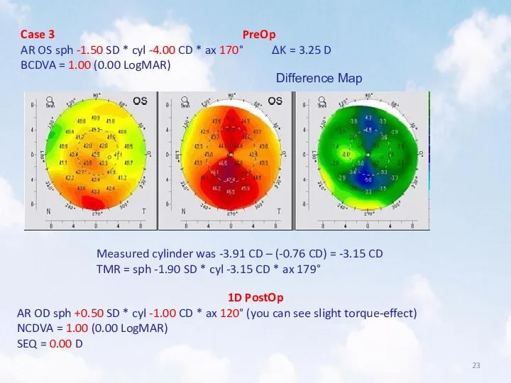 Case 3 PreOp AR OS sph -1.50 SD * cyl