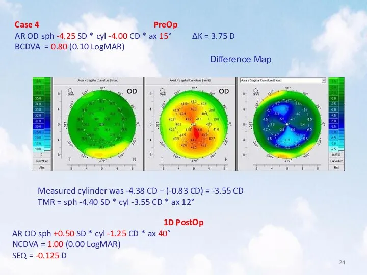 Case 4 PreOp AR OD sph -4.25 SD * cyl
