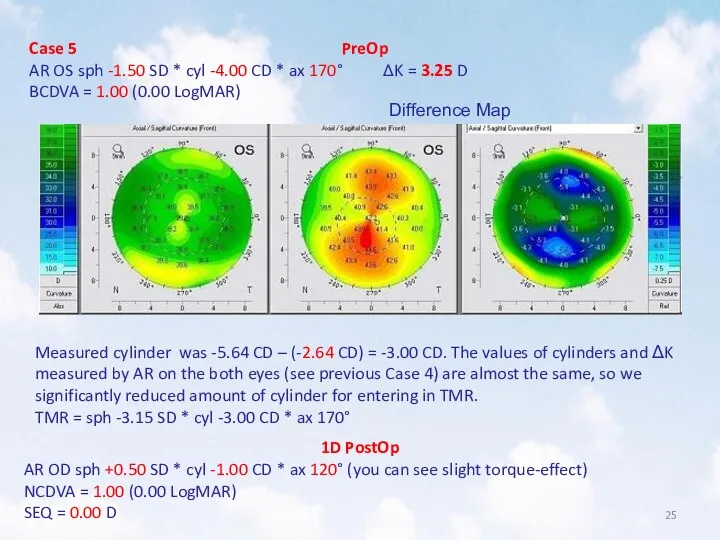 Case 5 PreOp AR OS sph -1.50 SD * cyl