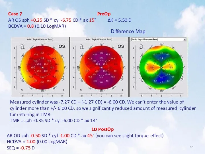 Case 7 PreOp AR OS sph +0.25 SD * cyl