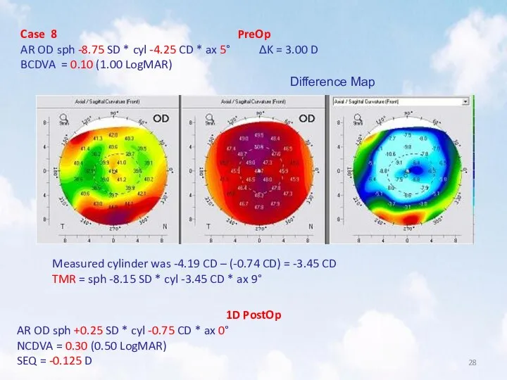 Case 8 PreOp AR OD sph -8.75 SD * cyl