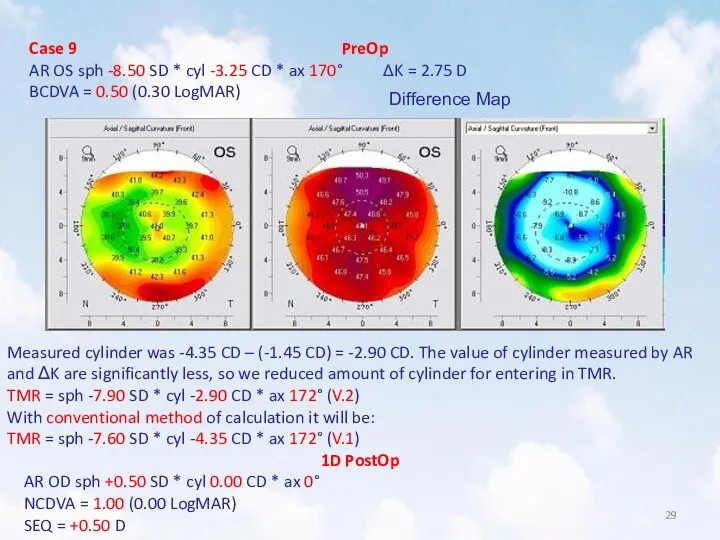 Case 9 PreOp AR OS sph -8.50 SD * cyl