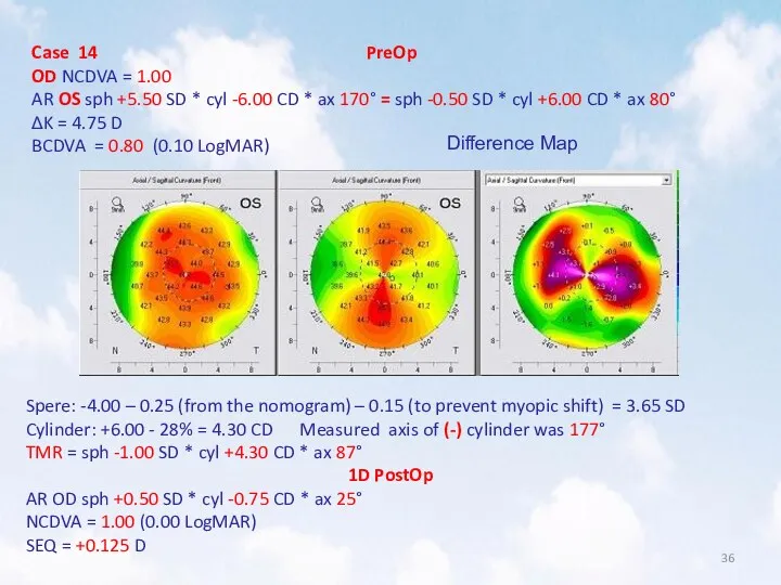 Case 14 PreOp OD NCDVA = 1.00 AR OS sph