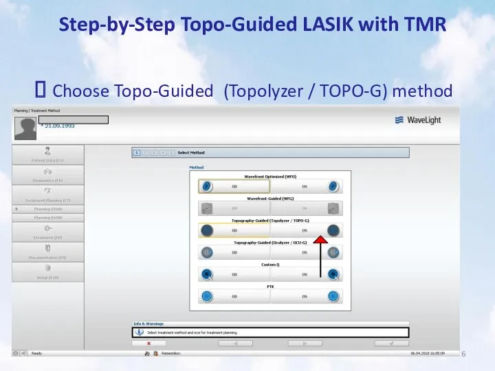 Step-by-Step Topo-Guided LASIK with TMR Choose Topo-Guided (Topolyzer / TOPO-G) method