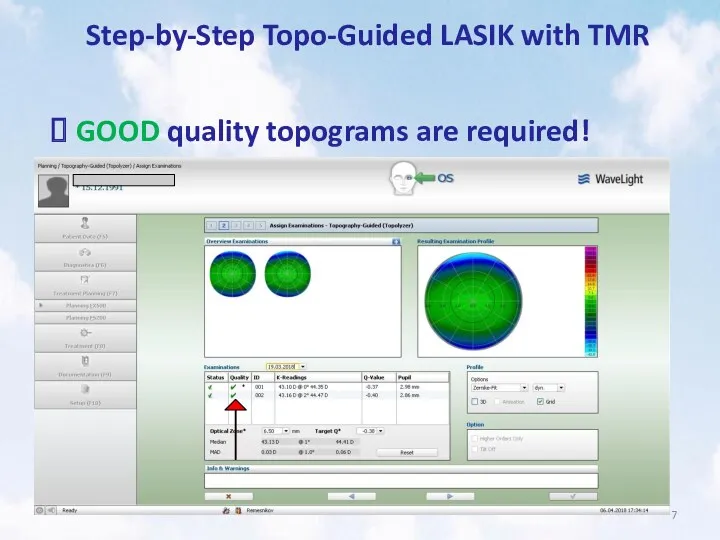 Step-by-Step Topo-Guided LASIK with TMR GOOD quality topograms are required!