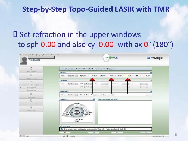 Step-by-Step Topo-Guided LASIK with TMR Set refraction in the upper