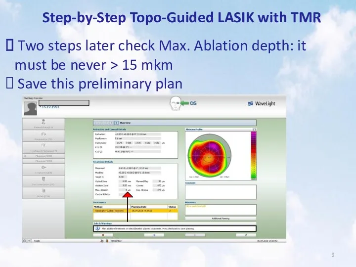 Step-by-Step Topo-Guided LASIK with TMR Two steps later check Max.