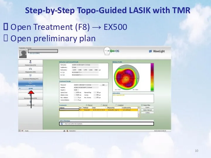 Step-by-Step Topo-Guided LASIK with TMR Open Treatment (F8) → EX500 Open preliminary plan