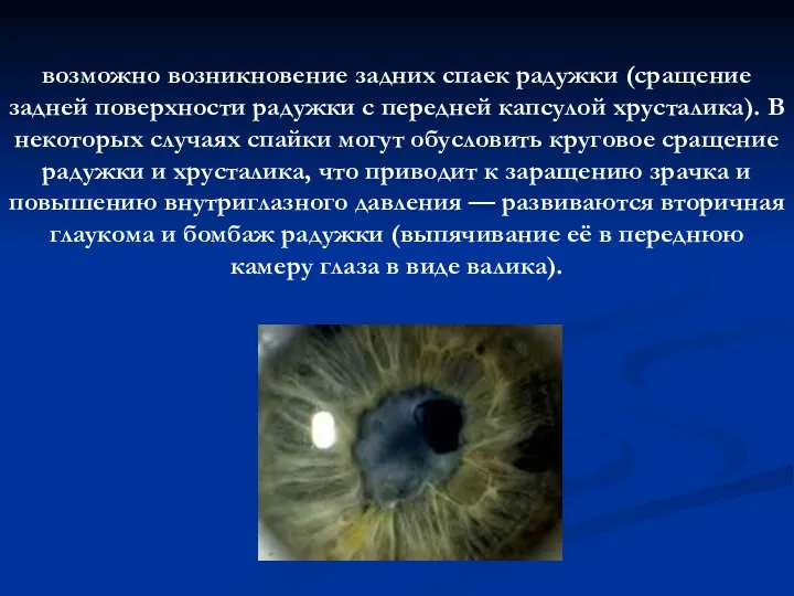 возможно возникновение задних спаек радужки (сращение задней поверхности радужки с