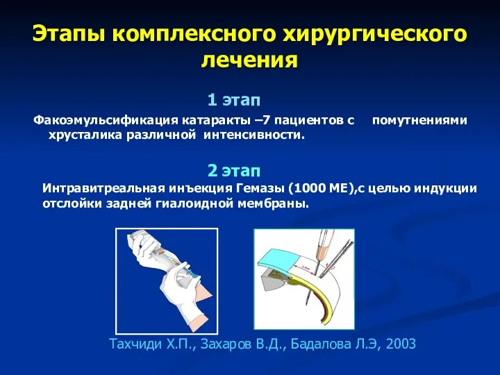 Этапы комплексного хирургического лечения 1 этап Факоэмульсификация катаракты –7 пациентов