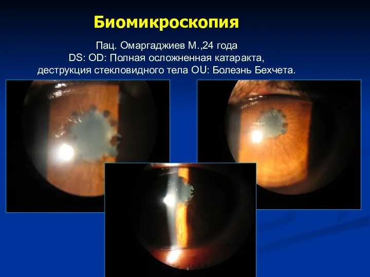Биомикроскопия Пац. Омаргаджиев М.,24 года DS: OD: Полная осложненная катаракта, деструкция стекловидного тела OU: Болезнь Бехчета.
