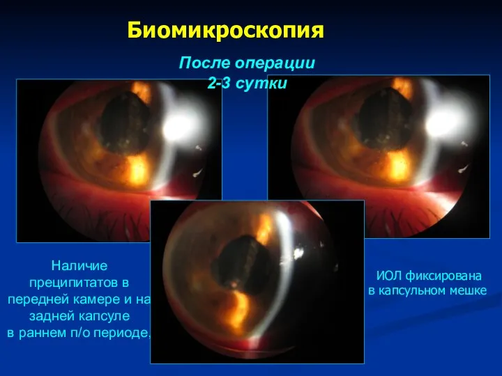 Биомикроскопия После операции 2-3 сутки ИОЛ фиксирована в капсульном мешке