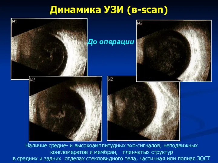 Динамика УЗИ (в-scan) До операции Наличие средне- и высокоамплитудных эхо-сигналов,