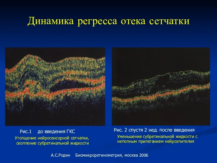 Динамика регресса отека сетчатки Утолщение нейросенсорной сетчатки, скопление субретинальной жидкости