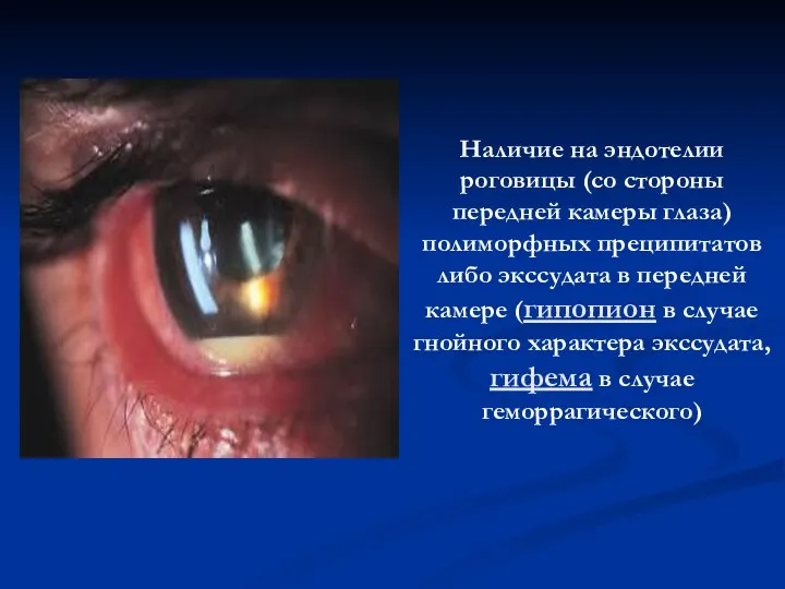Наличие на эндотелии роговицы (со стороны передней камеры глаза) полиморфных