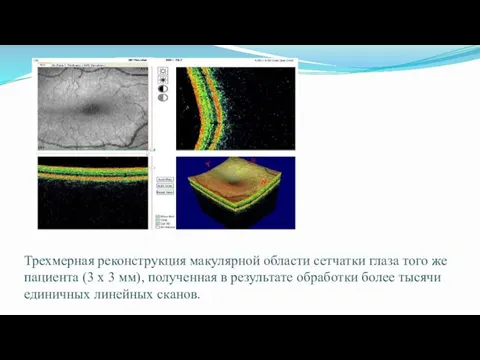 Трехмерная реконструкция макулярной области сетчатки глаза того же пациента (3