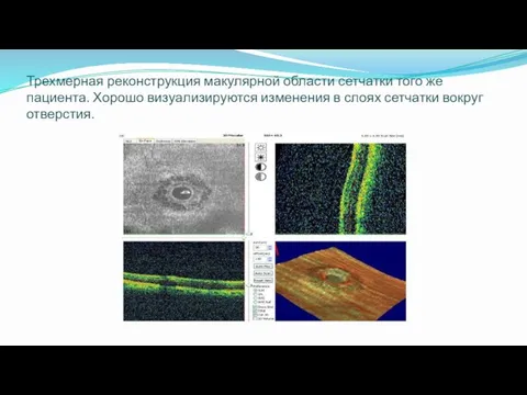 Трехмерная реконструкция макулярной области сетчатки того же пациента. Хорошо визуализируются изменения в слоях сетчатки вокруг отверстия.