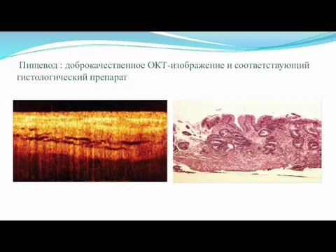 Пищевод : доброкачественное ОКТ-изображение и соответствующий гистологический препарат