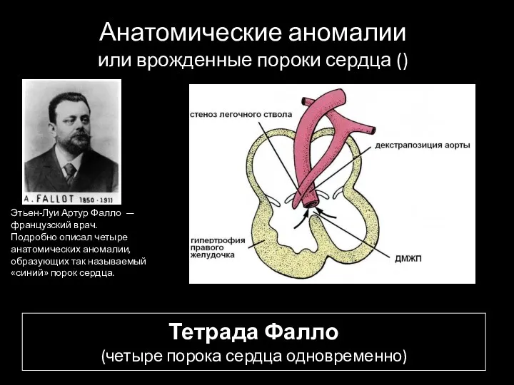 Тетрада Фалло (четыре порока сердца одновременно) Этьен-Луи Артур Фалло — французский врач. Подробно