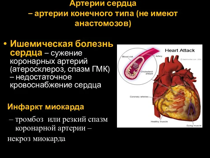 Артерии сердца – артерии конечного типа (не имеют анастомозов) Ишемическая болезнь сердца –