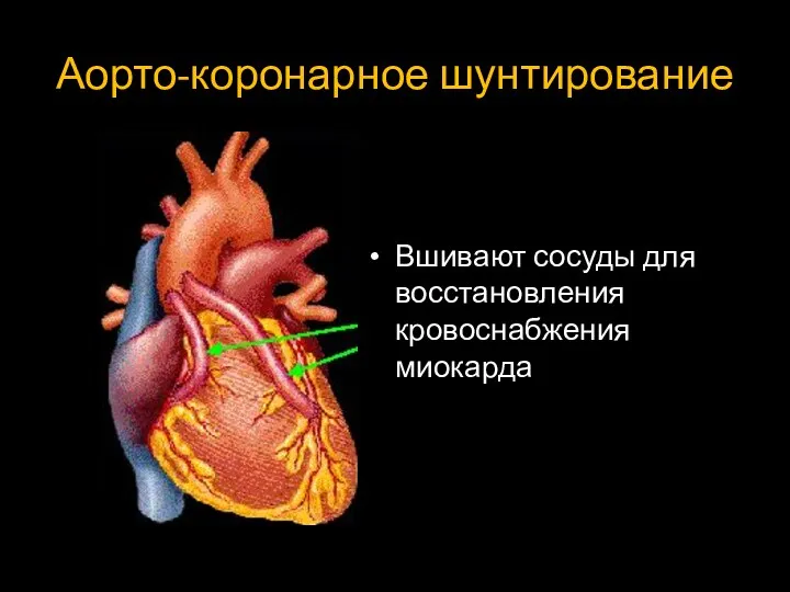 Аорто-коронарное шунтирование Вшивают сосуды для восстановления кровоснабжения миокарда