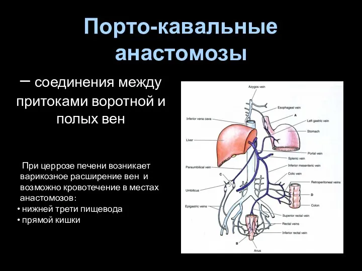 – соединения между притоками воротной и полых вен При церрозе печени возникает варикозное