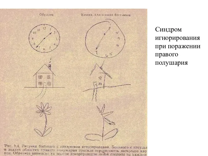 Синдром игнорирования при поражении правого полушария