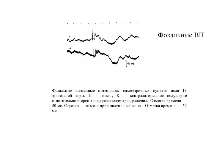 Фокальные вызванные потенциалы симметричных пунктов поля 18 зрительной коры. И