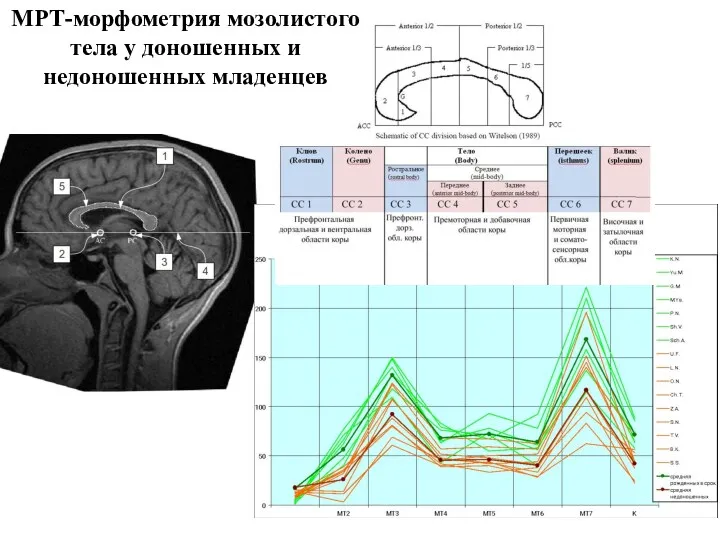 МРТ-морфометрия мозолистого тела у доношенных и недоношенных младенцев
