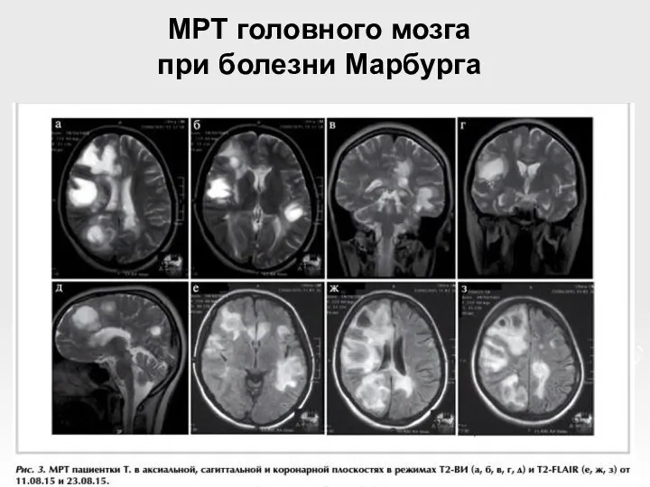 МРТ головного мозга при болезни Марбурга