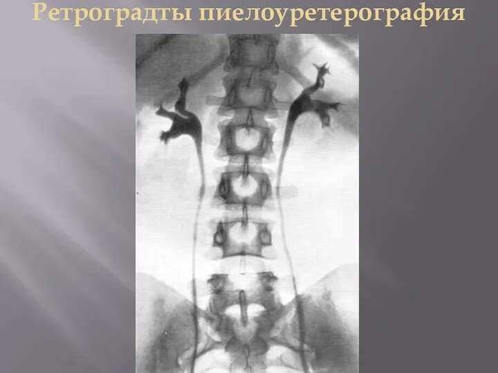 Ретроградты пиелоуретерография