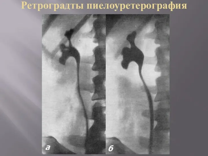 Ретроградты пиелоуретерография