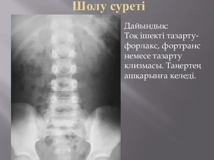 Шолу суреті Дайындық: Тоқ ішекті тазарту- форлакс, фортранс немесе тазарту клизмасы. Таңертең ашқарынға келеді.