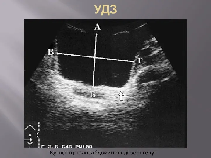 УДЗ Қуықтың трансабдоминальді зерттелуі