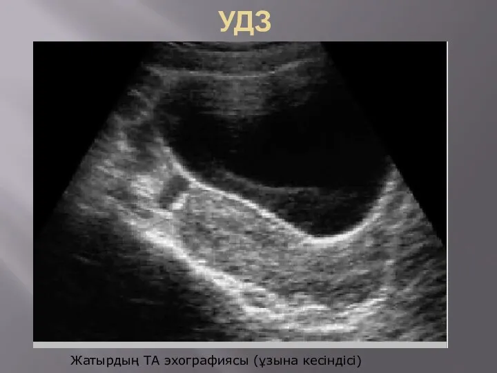 УДЗ Жатырдың ТА эхографиясы (ұзына кесіндісі)