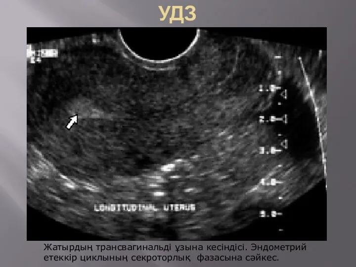 УДЗ Жатырдың трансвагинальді ұзына кесіндісі. Эндометрий етеккір циклының секроторлық фазасына сәйкес.