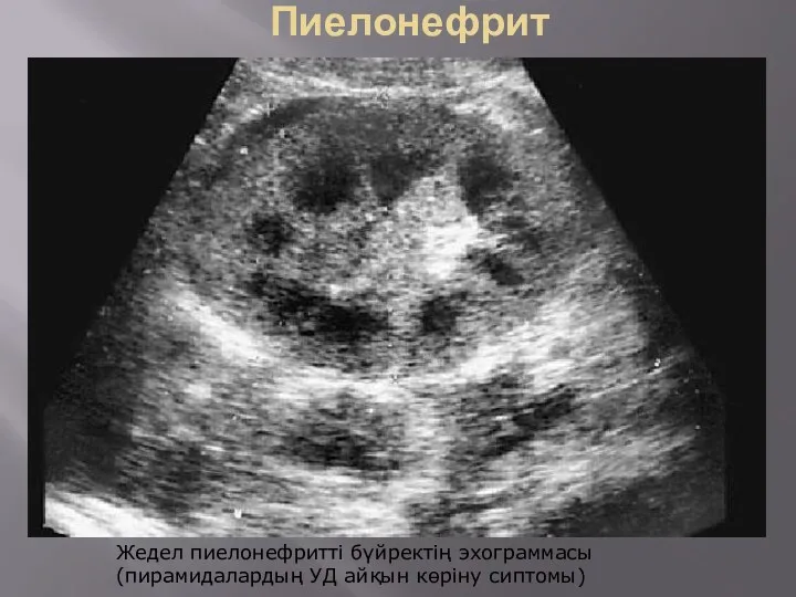 Пиелонефрит Жедел пиелонефритті бүйректің эхограммасы (пирамидалардың УД айқын көріну сиптомы)