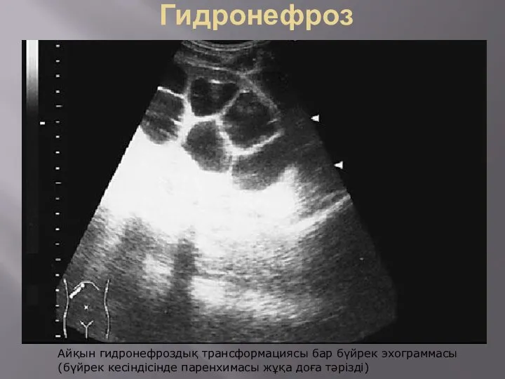 Гидронефроз Айқын гидронефроздық трансформациясы бар бүйрек эхограммасы (бүйрек кесіндісінде паренхимасы жұқа доға тәрізді)