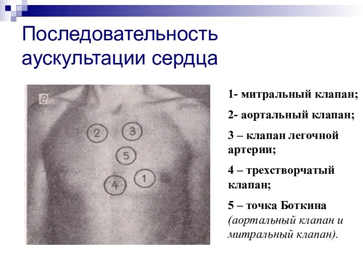 Последовательность аускультации сердца 1- митральный клапан; 2- аортальный клапан; 3